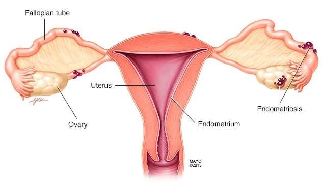 endometriosis